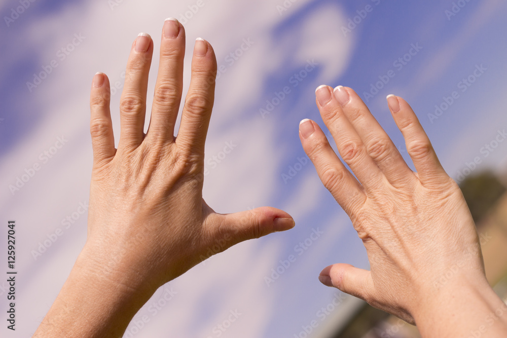 Woman hands with osteoarthritis Woman hands with osteoarthritis