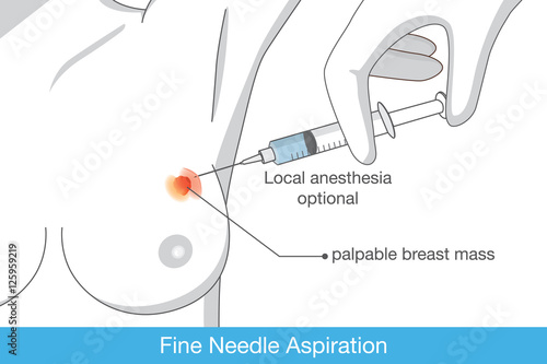 Drainage of breast cyst with needle for find breast cancer from sample. Illustration about breast cancer disease.
