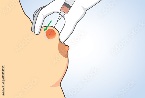 Drainage of breast cyst with needle for find breast cancer from sample. Illustration about breast cancer disease.
