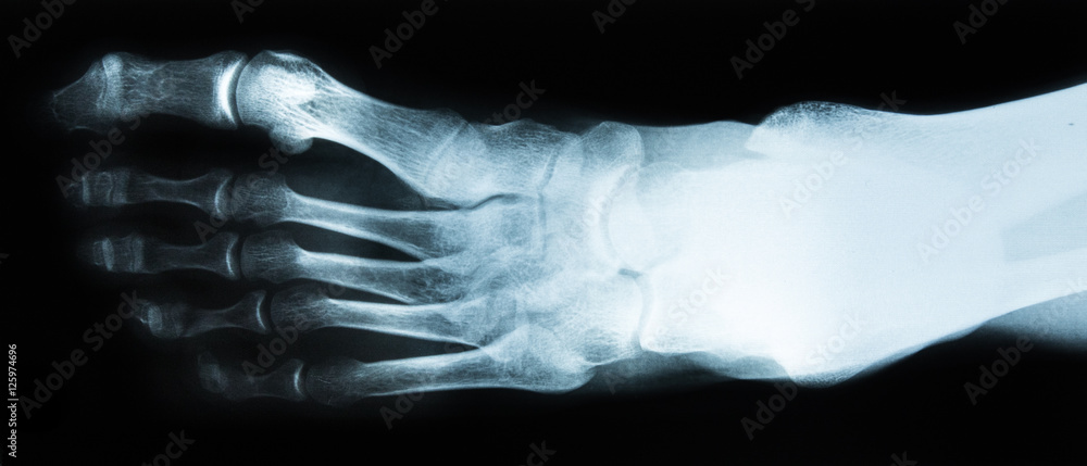 Fuß Röntgen Aufnahme von oben Stock Photo | Adobe Stock