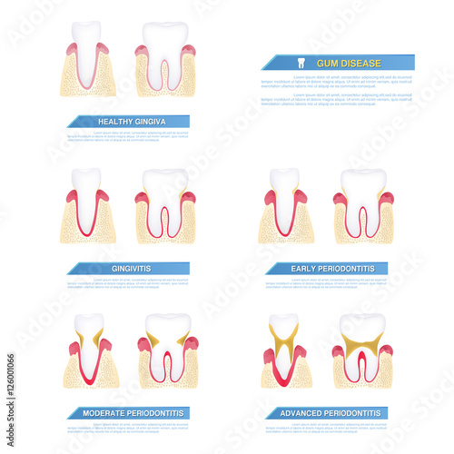 the progress of periodontal disease, gum disease..