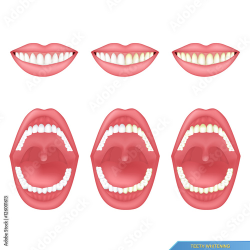 set of mouth and teeth, tooth whitening..