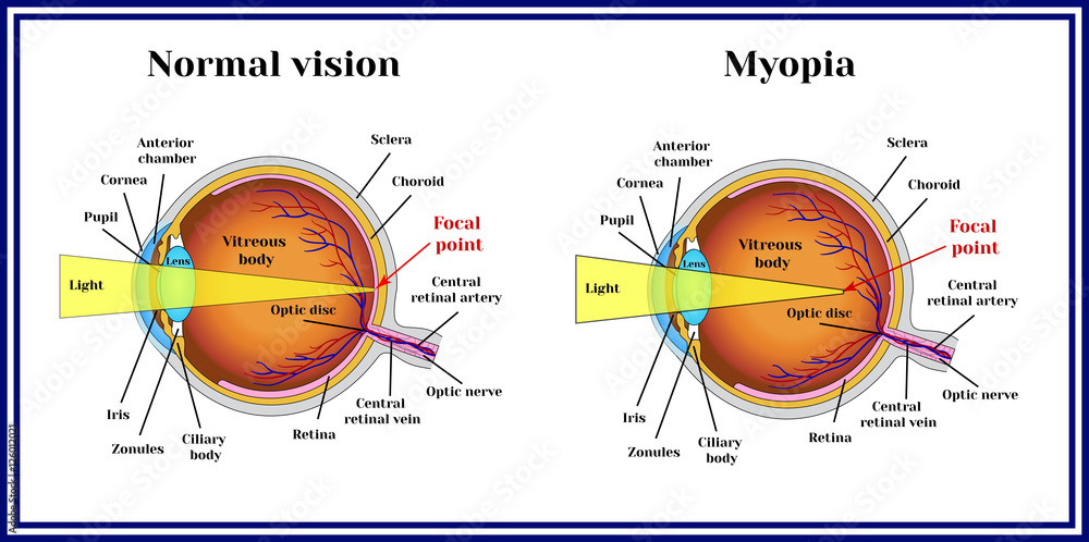 Foto Refractive errors eyeball. Myopia.