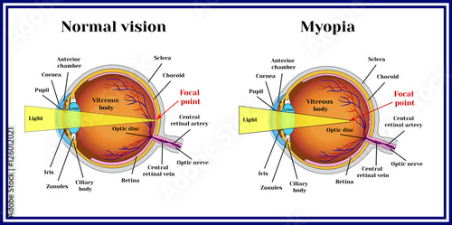 Refractive errors eyeball. Myopia. photo