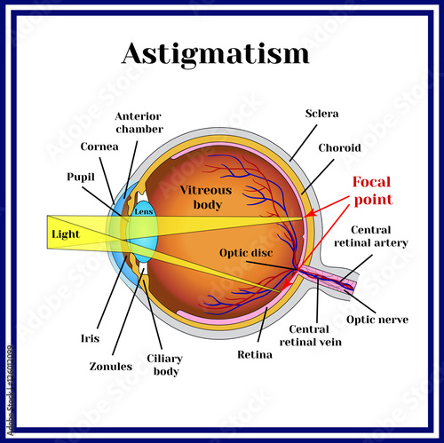 Refractive errors eyeball. Astigmatism.