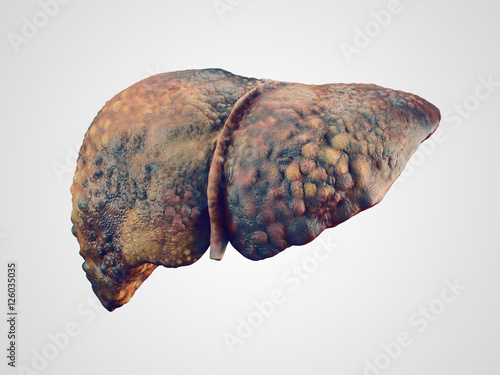 Realistic illustration of cirrhosis of human liver photo