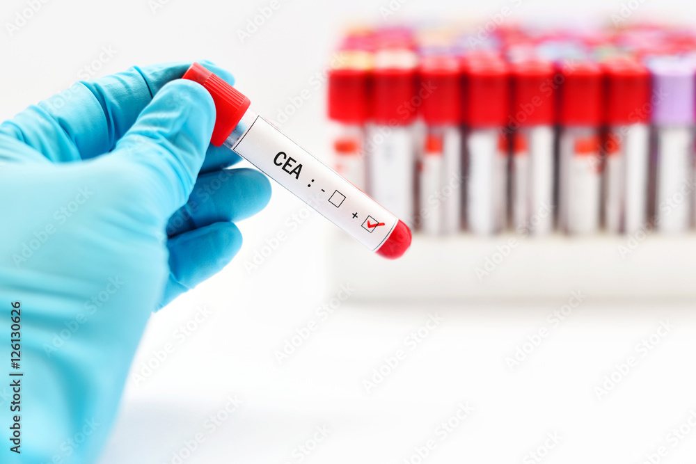 Obraz premium CEA (Carcinoembryonic antigen) positive, colon cancer diagnosis