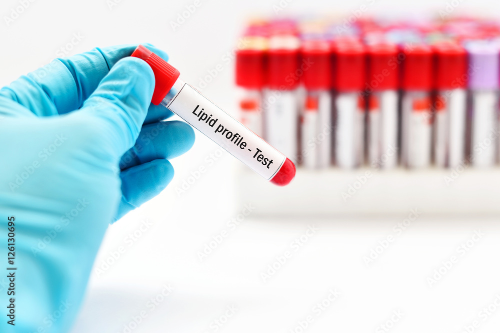 Obraz premium Lipid profile test