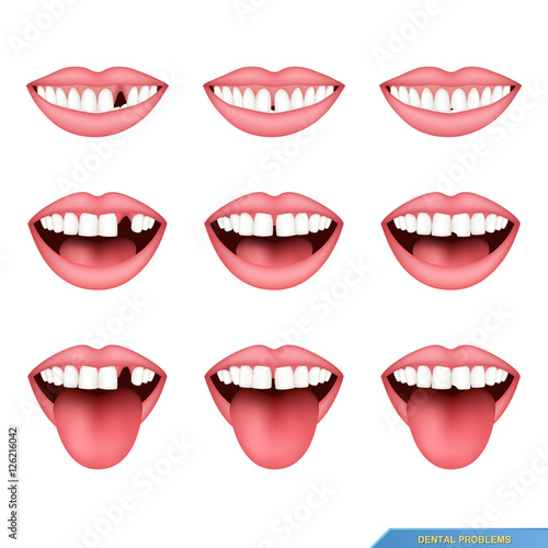 set of dental problems, missing teeth, gap between teeth, diastema, chipped tooth..