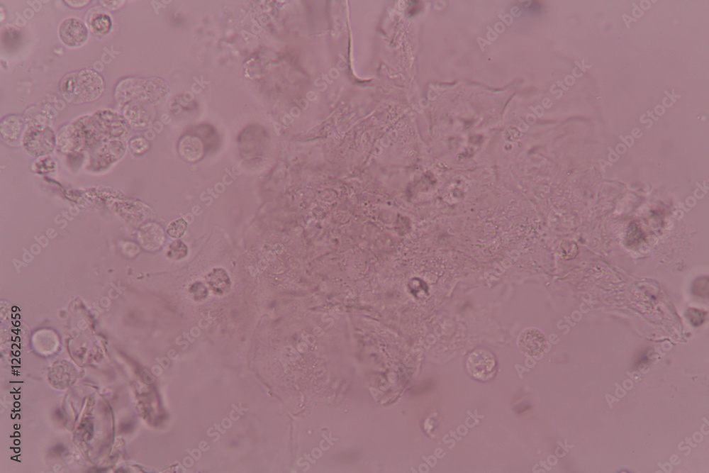 white blood cell clumping in urine white blood cell clumping in urine