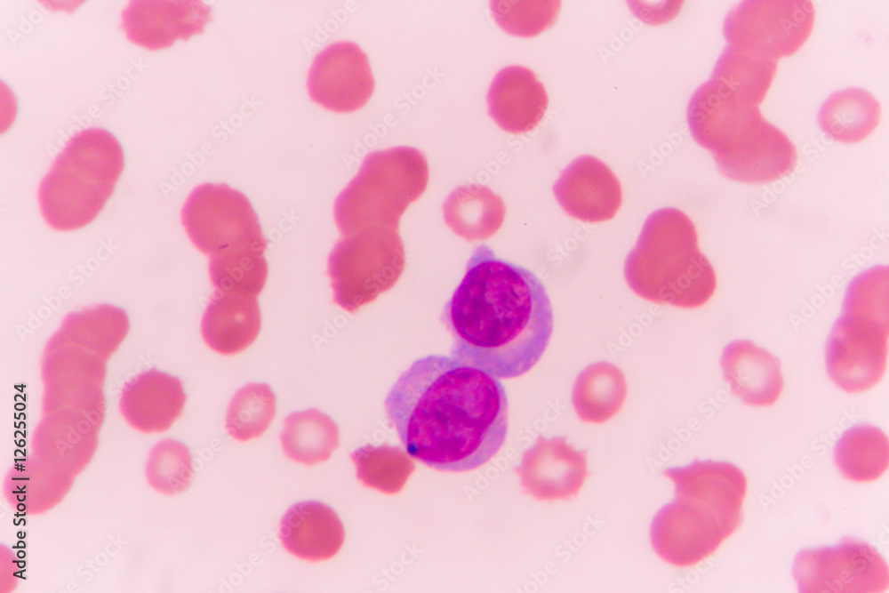 slide blood smear show plasme cell for complete blood count slide blood smear show plasme cell for complete blood count