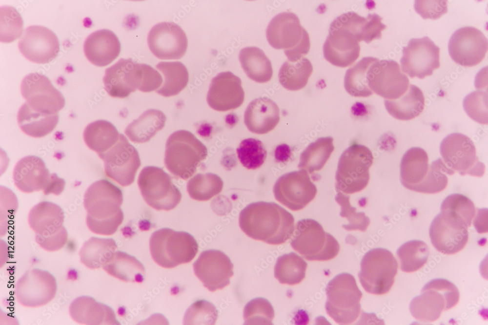 in Slide blood smear show giant platelet under microscope