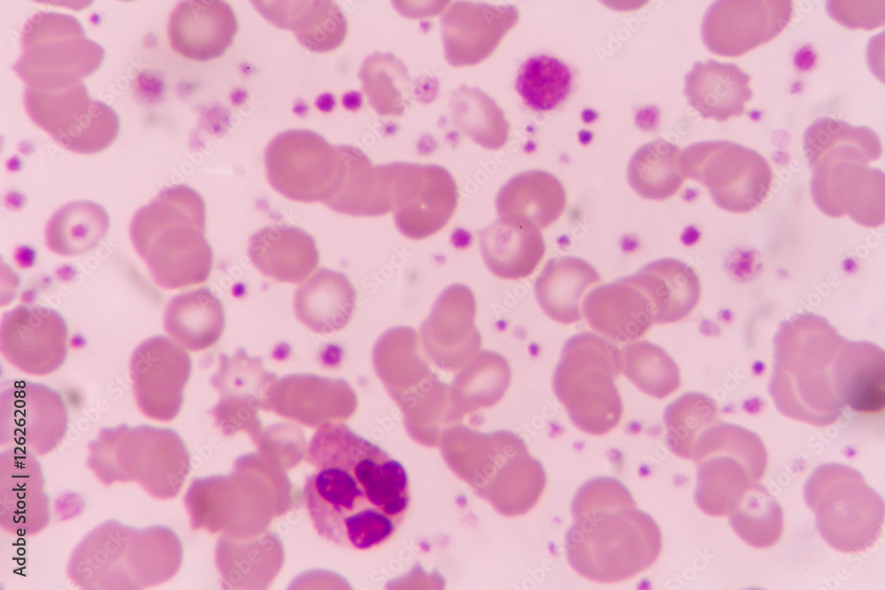 in Slide blood smear show giant platelet under microscope in Slide blood smear show giant platelet under microscope