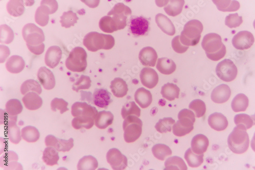 in Slide blood smear show giant platelet under microscope