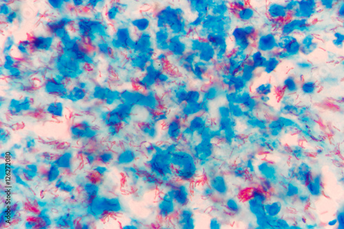 Mycobacterium tuberculosis undermicroscope photo