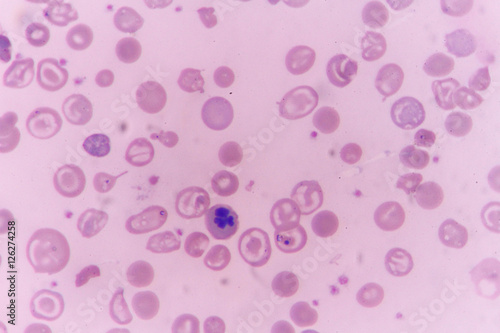 in slide blood smear show Nucleated red cell for complete blood count photo