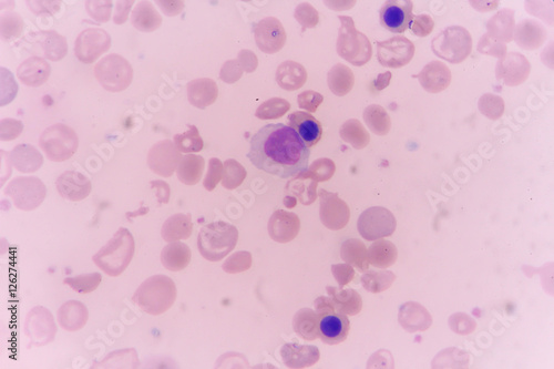 in slide blood smear show Nucleated red cell for complete blood count photo