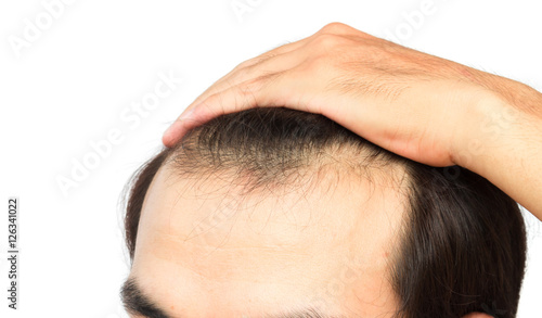 Young man serious hair loss problem for health care shampoo and