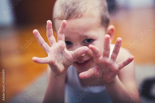 Boy with symptoms hand, foot and mouth disease photo