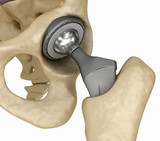 Hip replacement implant installed in the pelvis bone. Medically accurate 3D illustration