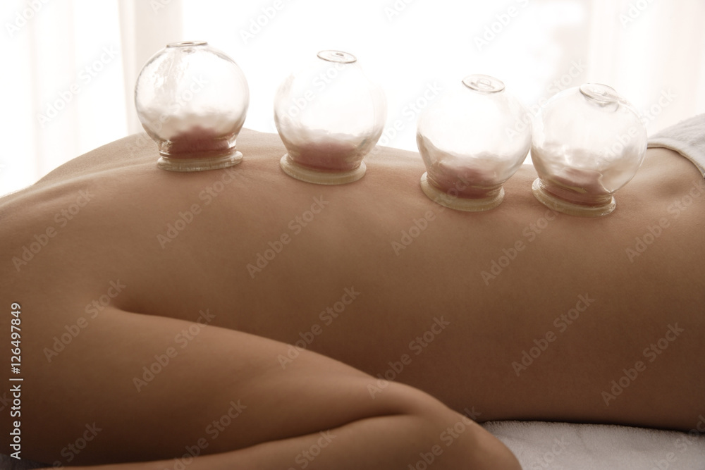 suction cup treatment on female back suction cup treatment on female back