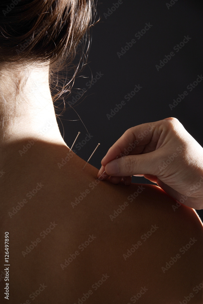 therapist applying acupuncture needles to woman's neck - obrazy, fototapety, plakaty 