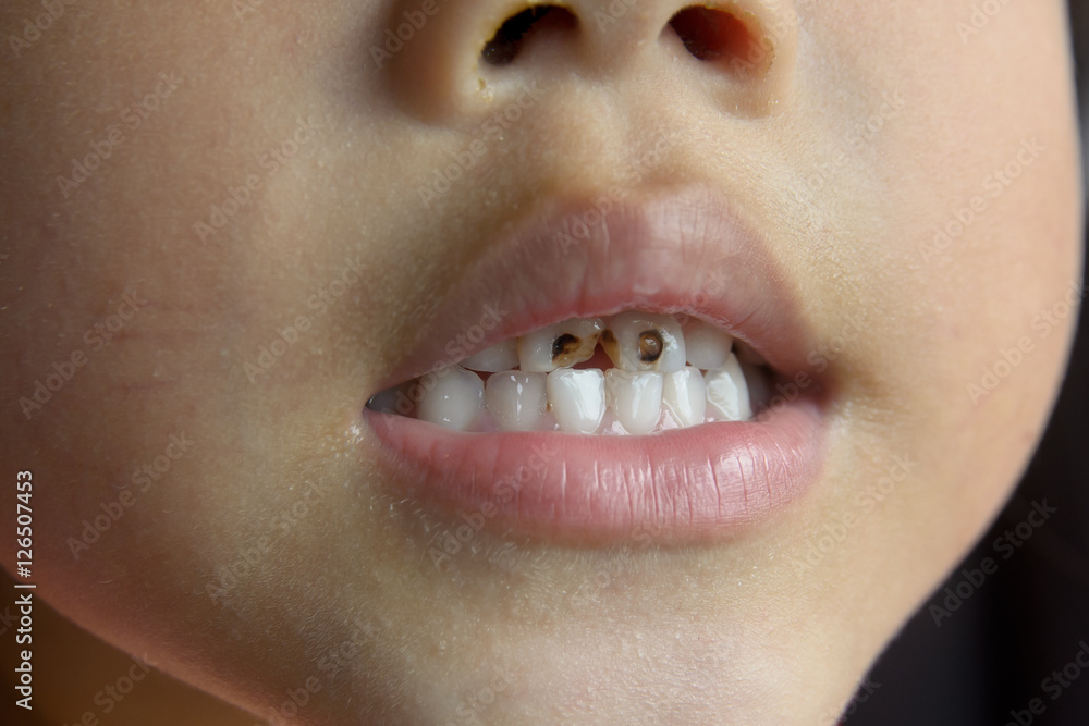 Obraz premium Child tooth decay. smiling children.