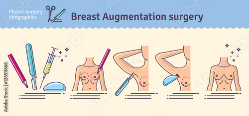 Vector Illustrated set with breast augmentation surgery