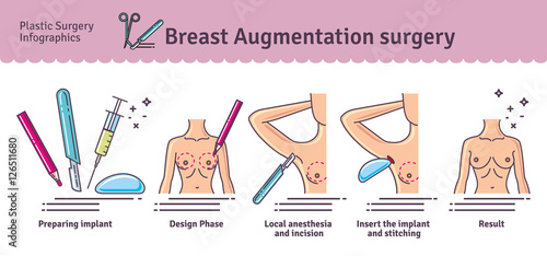 Vector Illustrated set with breast augmentation surgery