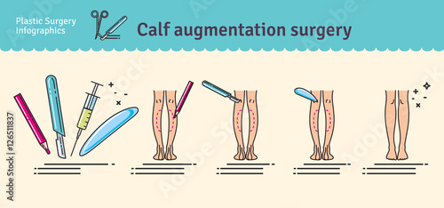 Vector Illustrated set with calf augmentation surgery