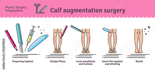 Vector Illustrated set with calf augmentation surgery