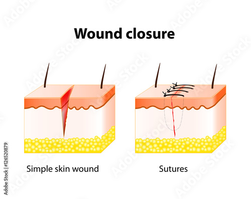 wound healing process with help surgical suture.