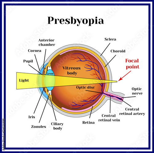 Refractive errors eyeball. Presbyopia. The lens loses its flexibility whith age. photo