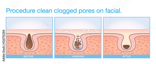 Procedure clean clogged pores on facial. Illustration about beauty and skin care.
