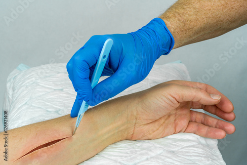 Hand with blue medical glove holding a scalpel making an incision on an arm. Open wound surgery. Close up horizontal view.