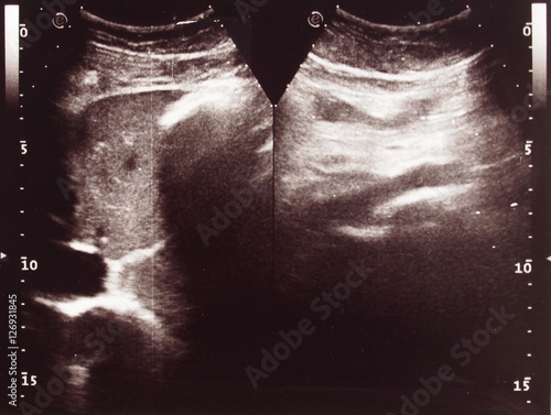 Diagnostic sonography of abdomen photo