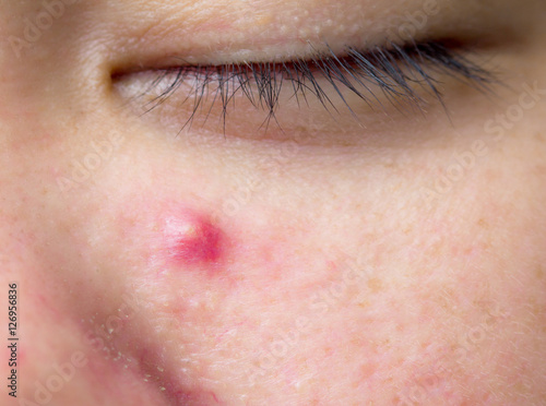 The infected pustulous acne on face, selective focus on acne