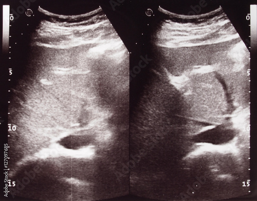 Diagnostic sonography of abdomen photo