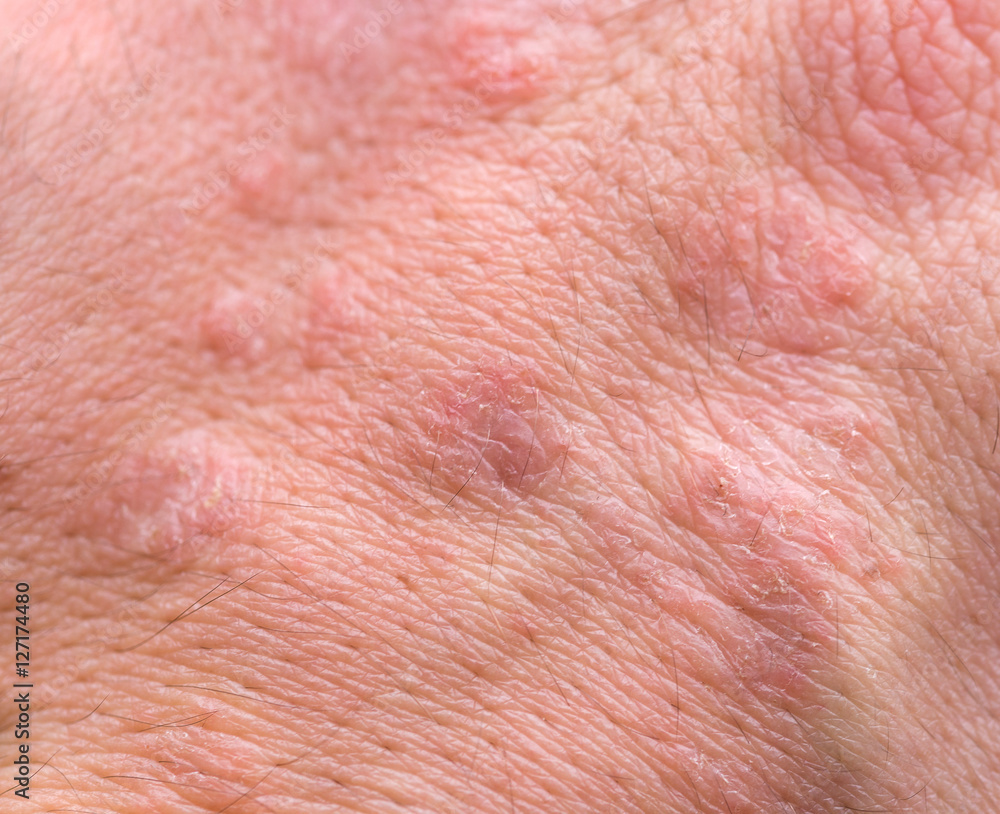 Fototapeta premium Allergy damaged human skin