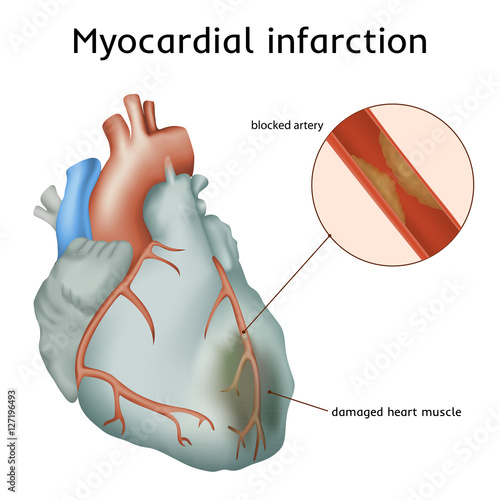 Myocardial infarction. Heart attack. Blocked artery, damaged heart muscle. Anatomy illustration. Colorful image, white background.