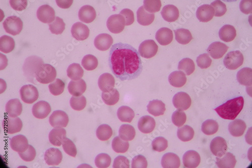 Blood smear shows large number of cancer leukemia cells(Blast cells)