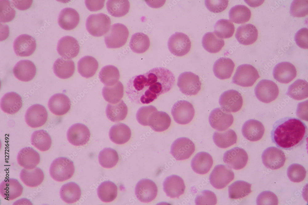 Blood smear shows large number of cancer leukemia cells(Blast cells)