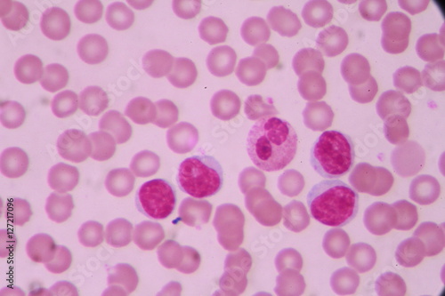 Blood smear shows large number of cancer leukemia cells(Blast cells)