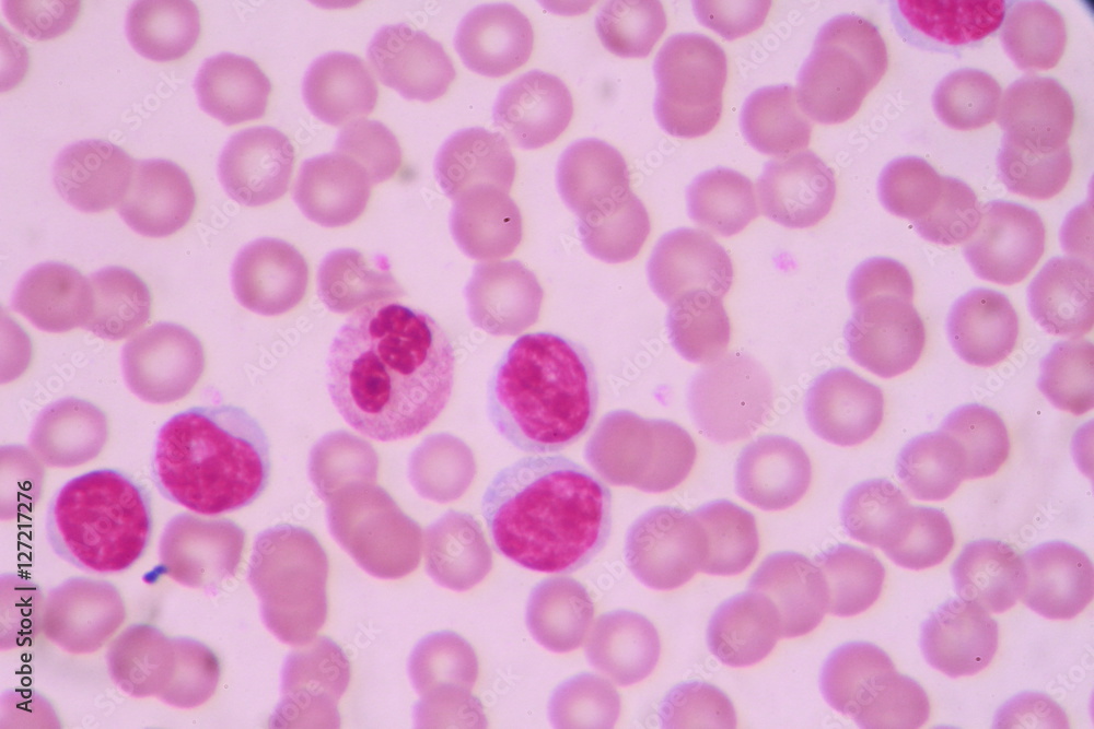 Blood smear shows large number of cancer leukemia cells(Blast cells) Blood smear shows large number of cancer leukemia cells(Blast cells)