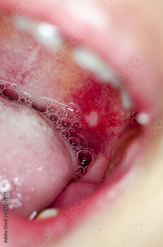 Macro close up and depth of field (DOF) infection  in open mouth - infection of ulcer inside mouth