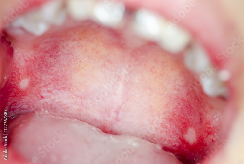 Macro close up and depth of field (DOF) infection  in open mouth - infection of ulcer inside mouth