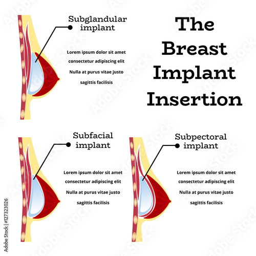 Plastic surgery of silicone breast implant,vector illustration.Female chest anatomy structure - medical wallpaper manual for implantaion,implant insertion or breast augmentation surgery