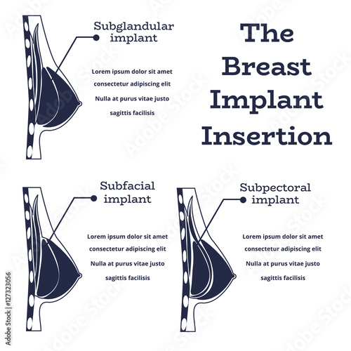 Plastic surgery of silicone breast implant,monochrome vector illustration.Female chest anatomy structure - medical wallpaper manual for implantaion,implant insertion or breast augmentation surgery