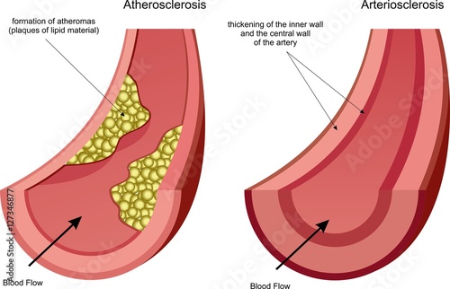 Healthy and atherosclerosis vessels