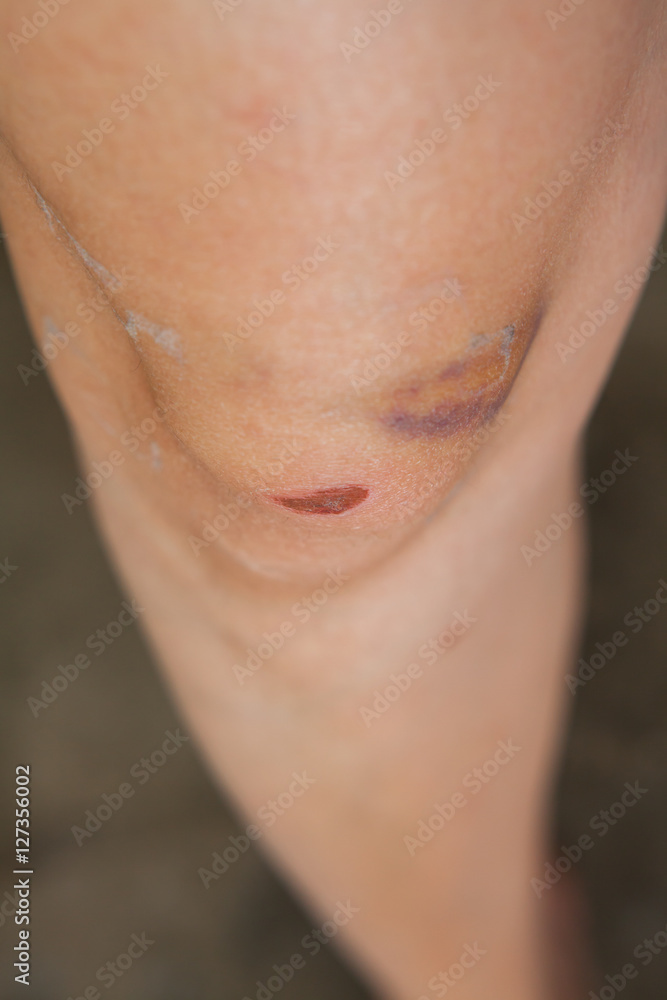 Naklejka premium Scratch on the knee caused by a fall.
